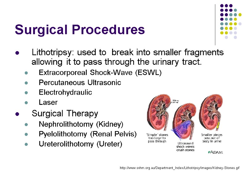 Surgical Procedures Lithotripsy: used to  break into smaller fragments allowing it to pass